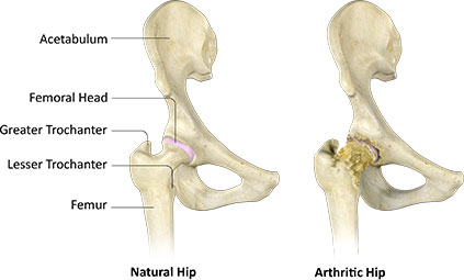 difference between natural hip and arthritic hip